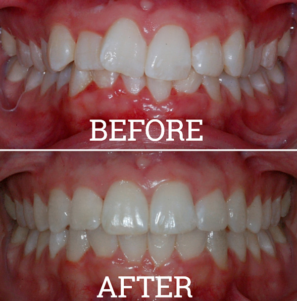 Invisalign Case