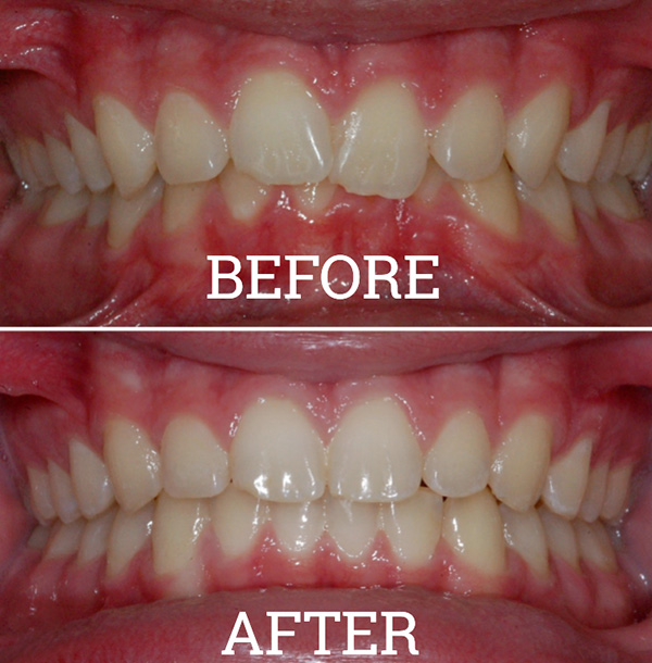 Invisalign Case