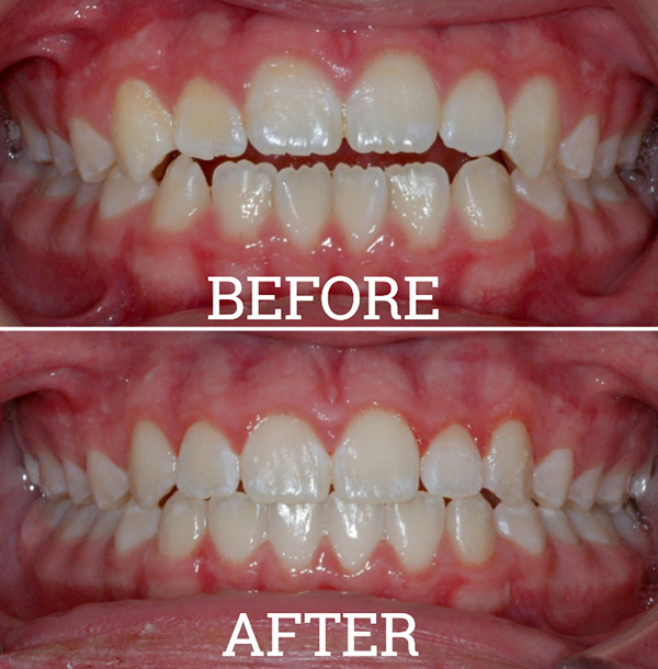 Invisalign Case