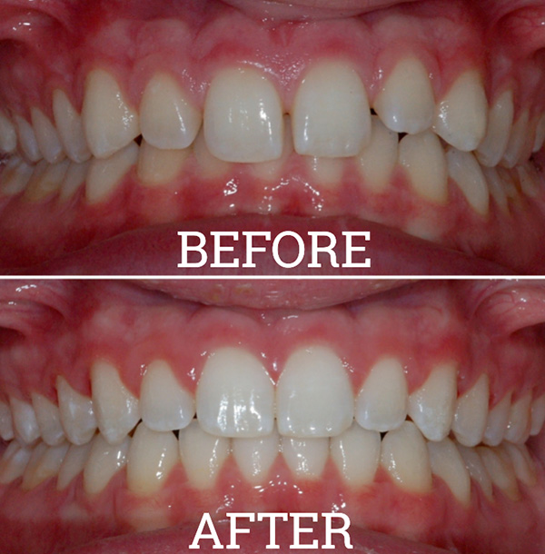 Invisalign Case