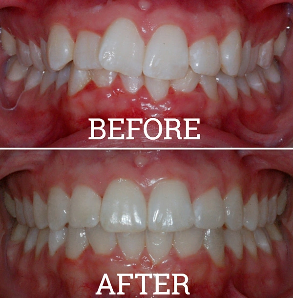 Teeth Before And After Invisalign® Treatment