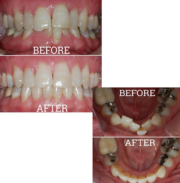 Teeth Before And After Invisalign® Treatment