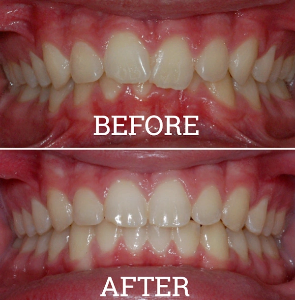 Teeth Before And After Invisalign® Treatment