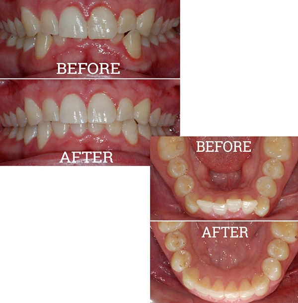 Teeth Before And After Invisalign® Treatment