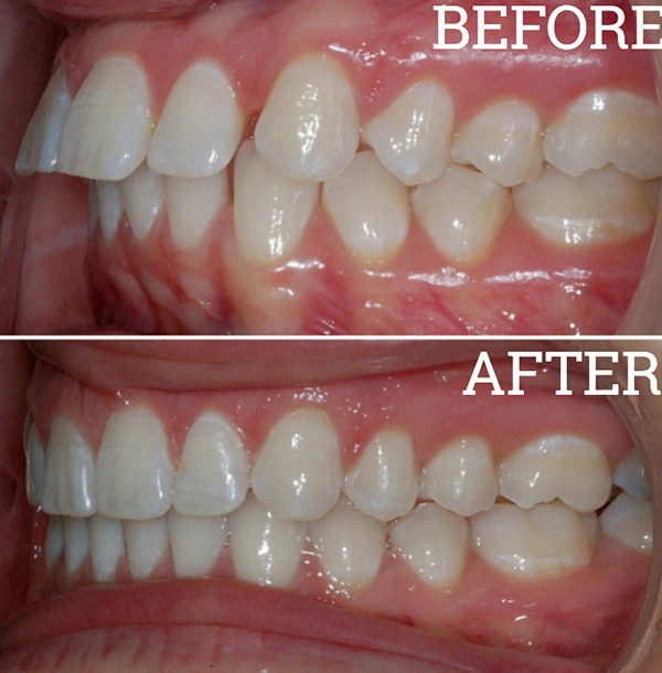 Teeth Before And After Invisalign® Treatment