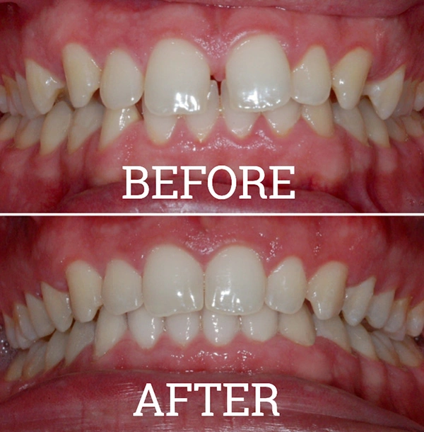 Teeth Before And After Invisalign® Treatment