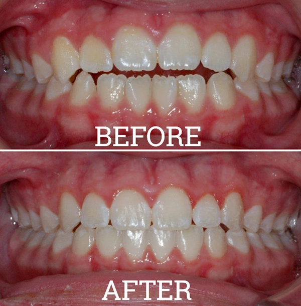 Teeth Before And After Invisalign® Treatment