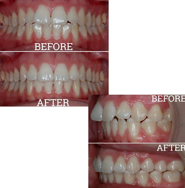 Teeth Before And After Invisalign® Treatment
