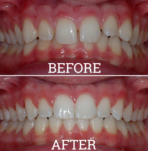 Teeth Before And After Invisalign® Treatment