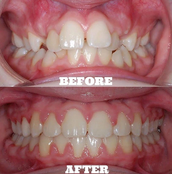 Teeth Before And After Orthodontic Treatment