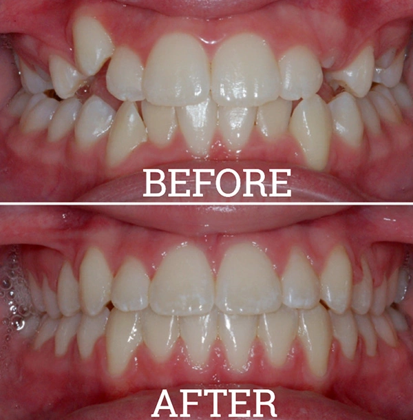 Teeth Before And After Orthodontic Treatment