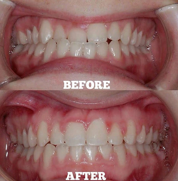 Teeth Before And After Orthodontic Treatment