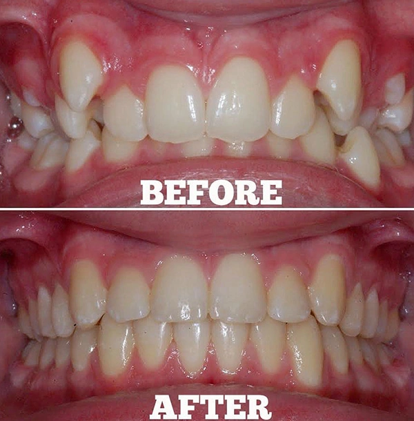 Teeth Before And After Orthodontic Treatment