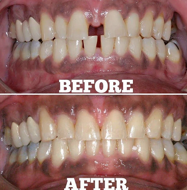 Teeth Before And After Orthodontic Treatment