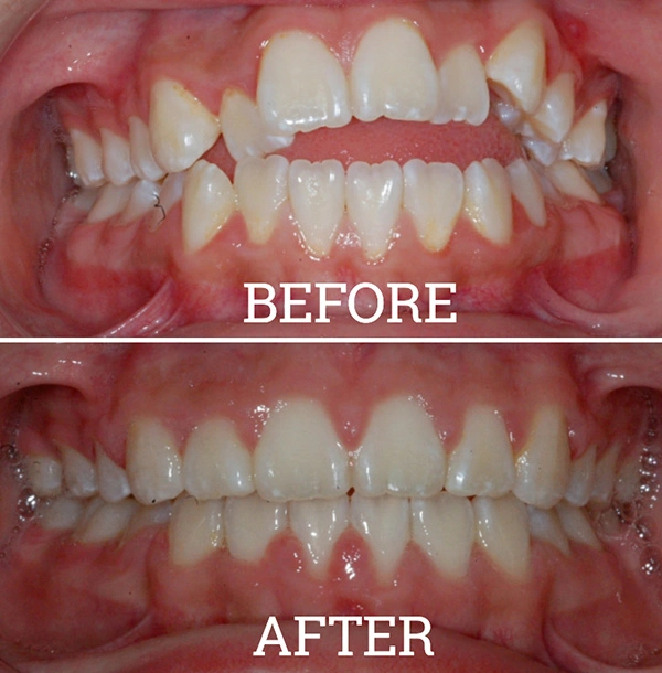 Teeth Before And After Orthodontic Treatment