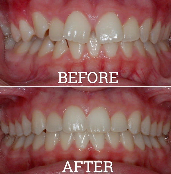 Teeth Before And After Orthodontic Treatment