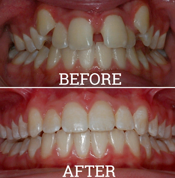 Teeth Before And After Orthodontic Treatment