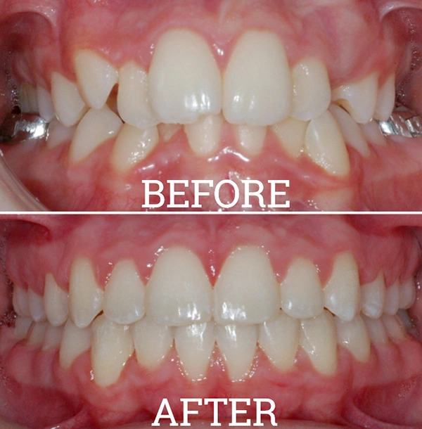 Teeth Before And After Orthodontic Treatment