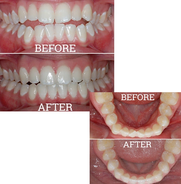 Teeth Before And After Orthodontic Treatment